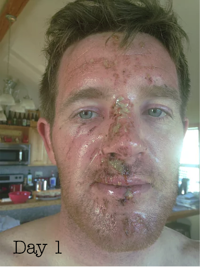 Patrick on Day one with Essential Oil Healing