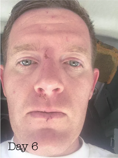 Patrick on Day Six with Essential Oil Healing